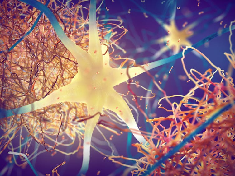 A digital drawing depicting amyloid and tau forming tangles and plaques around a nerve cell in the brain.